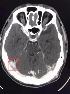 Case Report and Literature Review: Behçet’s Disease With a Novel TFPI Gene Mutation